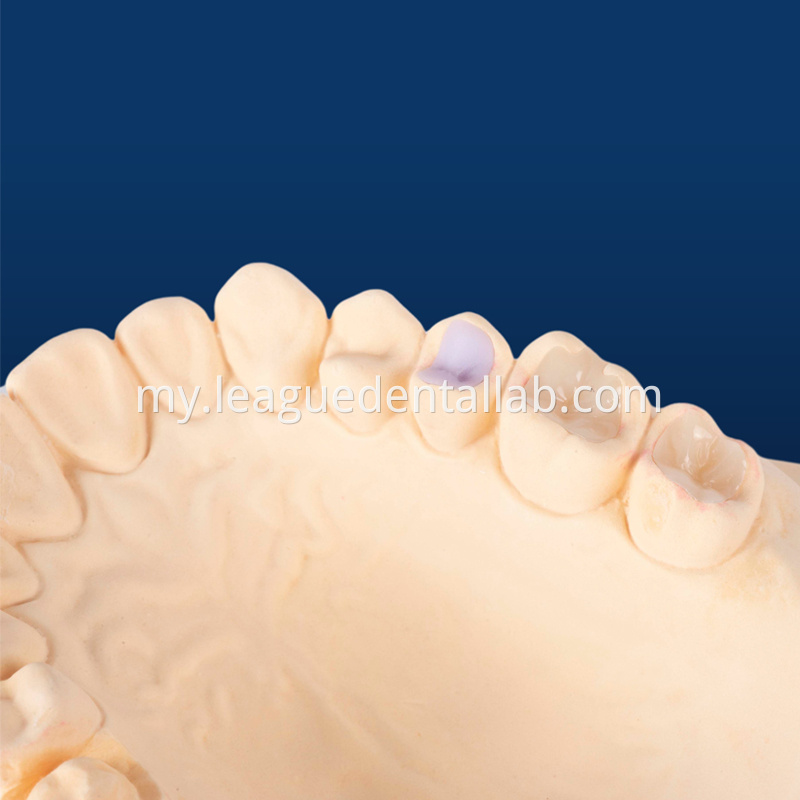 IPS Empress,Emax Onlay,Emax onlay,Emax Veneer,Lithium disilicate